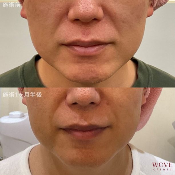 HIFUドットモード（全顔）1回