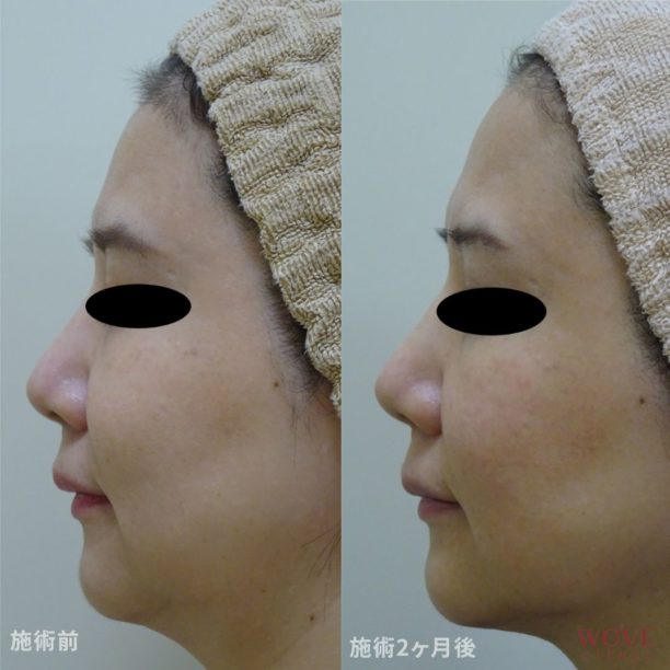 HIFUドットモード（全顔＋顎下）1回　