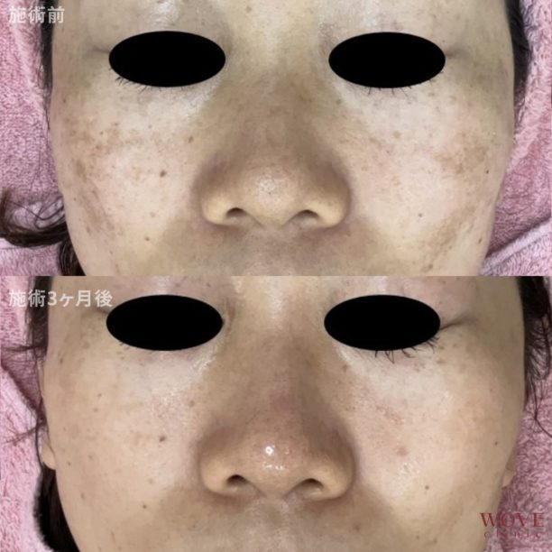 肝斑レーザートーニング（ピコトーニング）＆トラネキサム酸導入5回・ケミカルピーリング＆導入1回