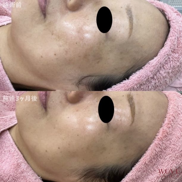 肝斑レーザートーニング（ピコトーニング）＆トラネキサム酸導入5回・ケミカルピーリング＆導入1回