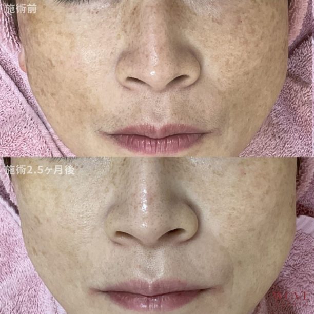 肝斑レーザートーニング&トラネキサム酸導入10回