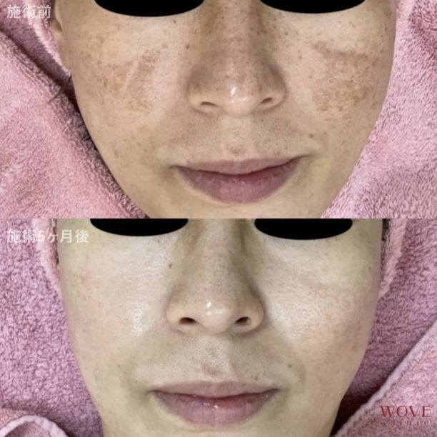 肝斑レーザートーニング＆トラネキサム酸導入10回・ケミカルピーリング＆導入5回