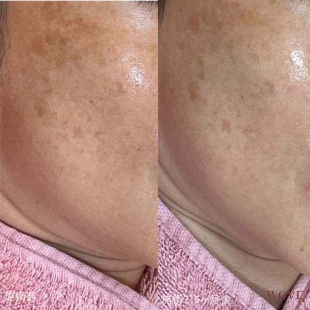 肝斑レーザートーニング&トラネキサム酸導入10回