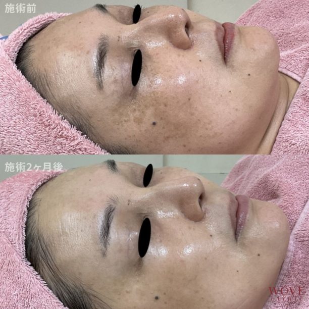 肝斑レーザートーニング＆トラネキサム酸導入（全顔・上下眼瞼）9回