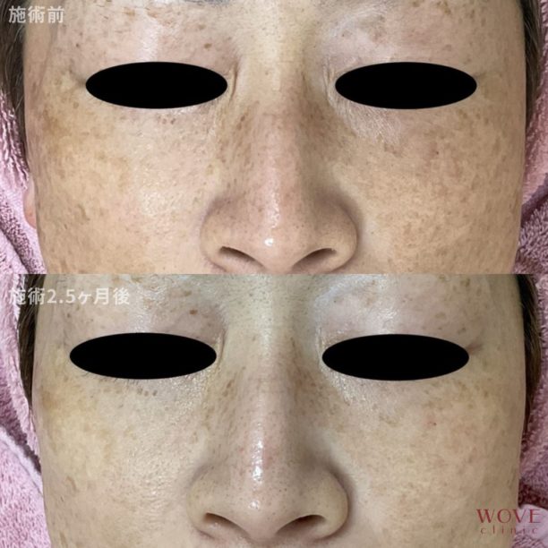 肝斑レーザートーニング&トラネキサム酸導入10回