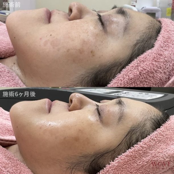 肝斑レーザートーニング＆トラネキサム酸導入6回・ケミカルピーリング＆ヒアルロン酸導入1回・フォトRFオーロラ2回