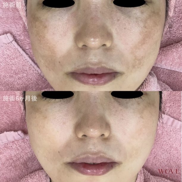 肝斑レーザートーニング＆トラネキサム酸導入10回・ケミカルピーリング5回　