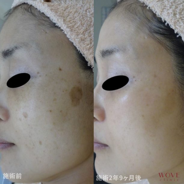 シミ取りレーザー1回・ケミカルピーリング5回・フォトRFオーロラ10回・肝斑レーザートーニング&トラネキサム酸導入9回・高濃度ビタミンC点滴13回