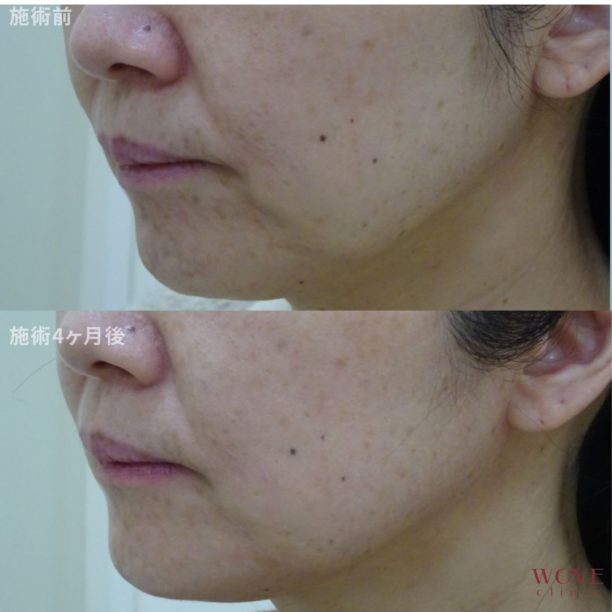 WOVEリフト（全顔）1回