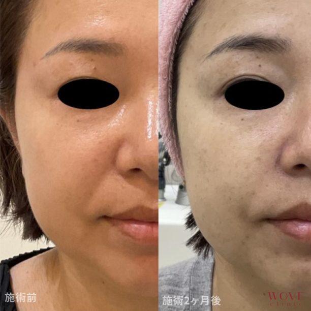 WOVEリフト（全顔＋顎下）1回