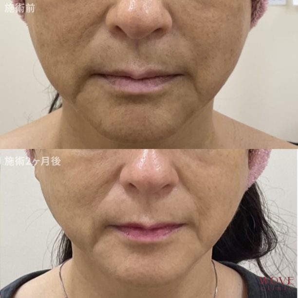 WOVEリフト（全顔＋顎下）1回・トリニティ（全顔）1回