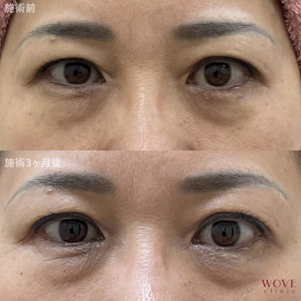 サーマアイ（目元専用）1回