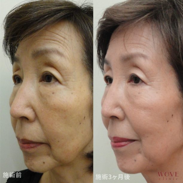 サーマフェイス1回