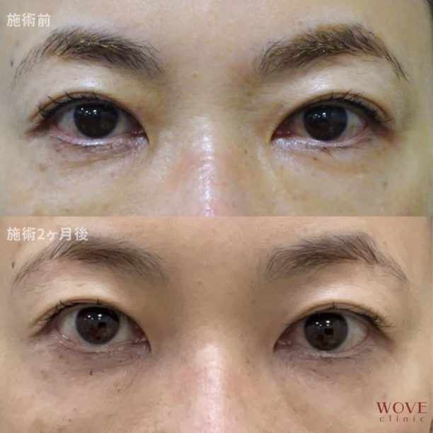 サーマアイ（目元専用）1回