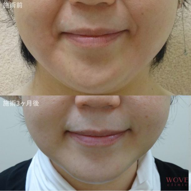 サーマフェイス1回・ヒアルロン酸注入1本