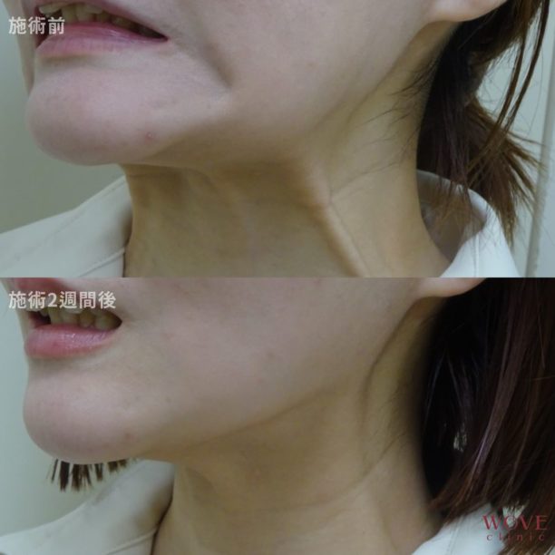 ボトックス注射（口角下制筋・広頚筋）　