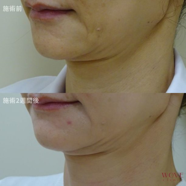 ボトックス注射（広頚筋）