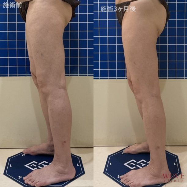 GF脂肪融解＋もみ出しマッサージ（下腿）10回