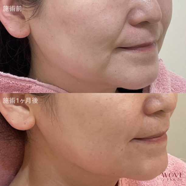 ヒアルロン酸リフト1回・ヒアルロン酸注入（法令線）1回・ボトックス注射（エラ）1回