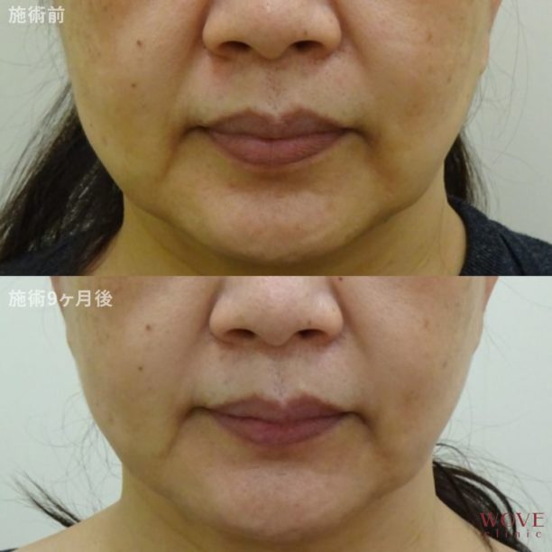 HIFUドットモード（全顔＋顎下）3回