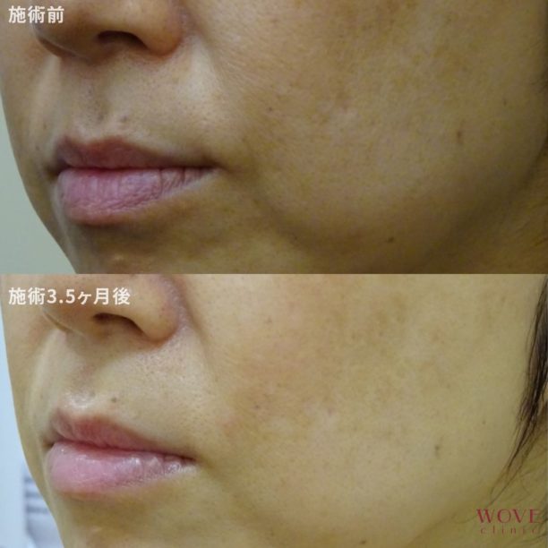 PRP皮膚再生療法～多血小板血漿注射～　1回