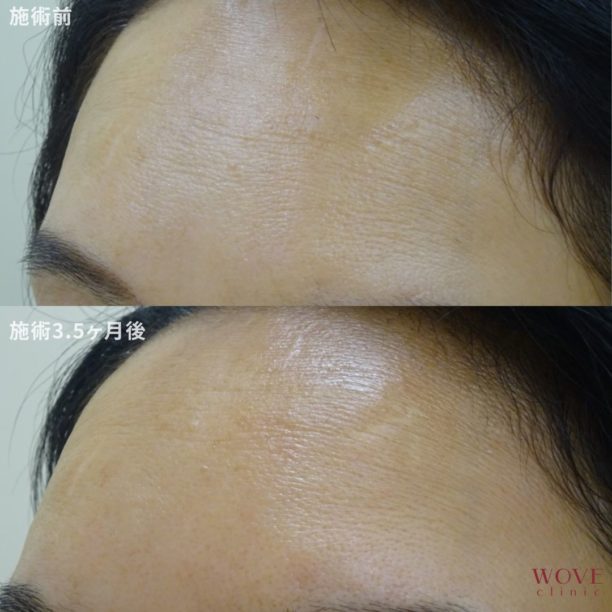 PRP皮膚再生療法～多血小板血漿注射～　1回