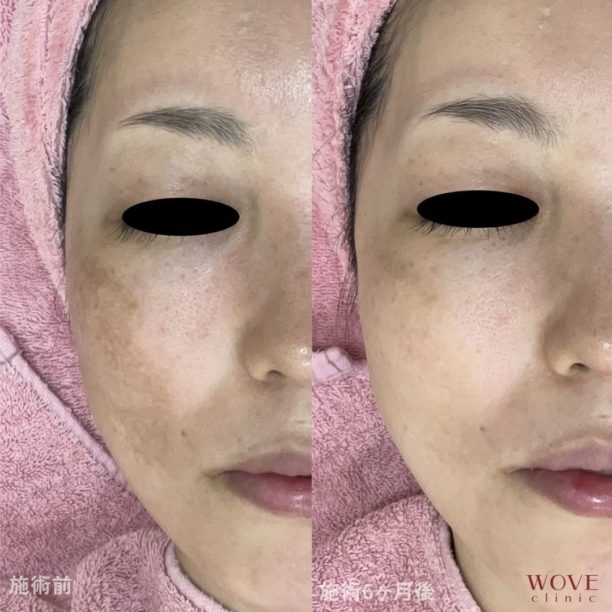 肝斑レーザートーニング＆トラネキサム酸導入10回・ケミカルピーリング5回