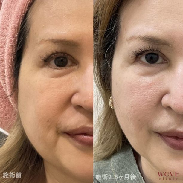 WOVEリフト（全顔＋顎下）1回
