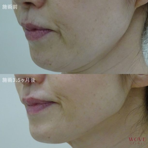 WOVEリフト（全顔＋顎下）1回