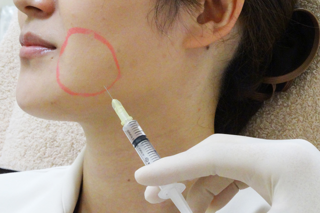 BNLS ultimate 注射