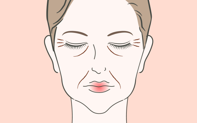 非公開: ヒアルロン酸リフト