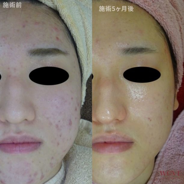 ケミカルピーリング＆導入（全顔）5回