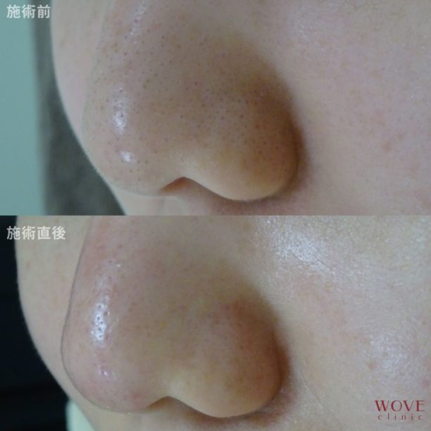 ケミカルピーリング＆導入（全顔）1回