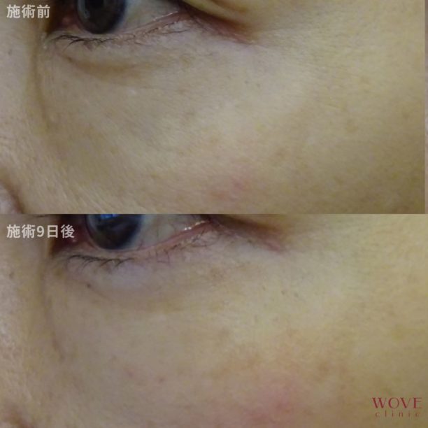 スネコス注射1回