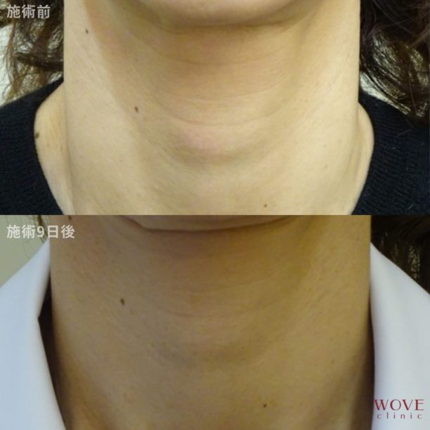 スネコス注射（首）1回