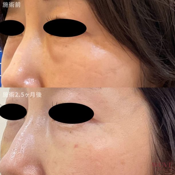 スネコス注射4回