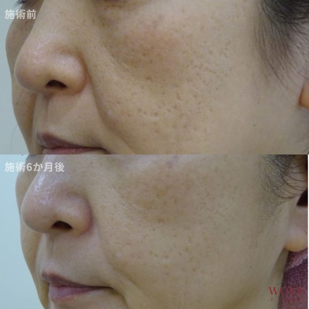 ダーマペン（全顔）ヴェルヴェットスキン1回・ウーバーピール1回