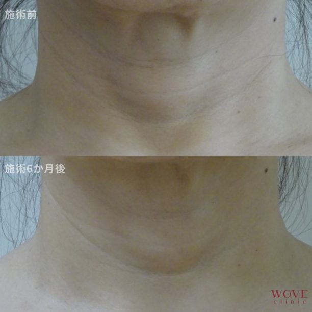 ダーマペン（首）ヴェルヴェットスキン2回