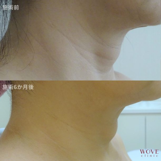 ダーマペン（首）ヴェルヴェットスキン2回