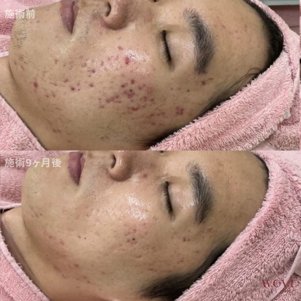 ダーマペン（全顔）ウーバーピール5回・ケミカルピーリング＆ビタミンC導入6回