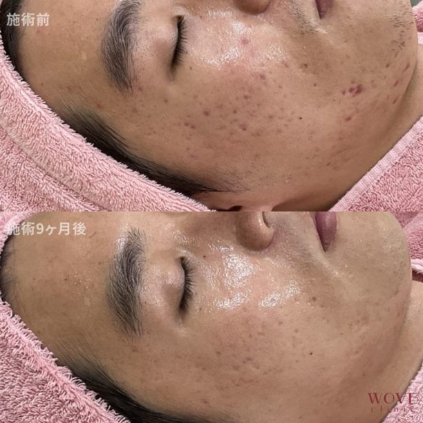 ダーマペン（全顔）ウーバーピール5回・ケミカルピーリング＆ビタミンC導入6回