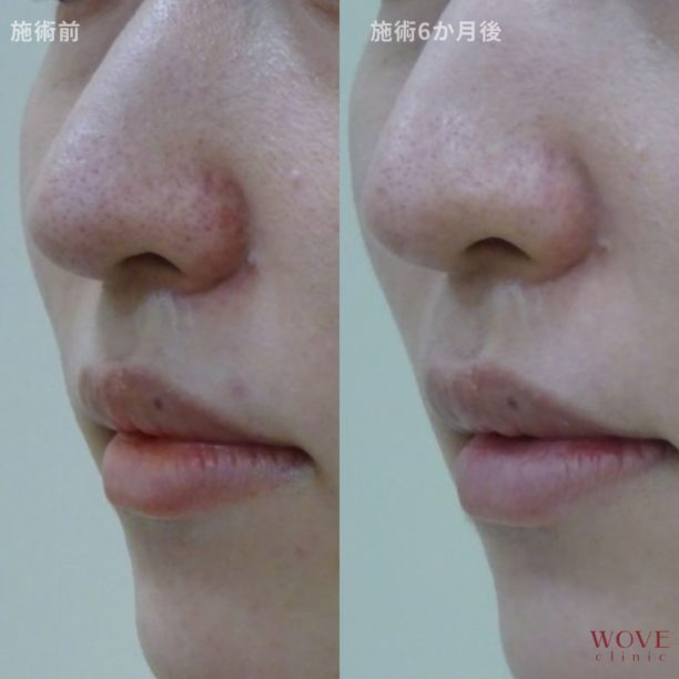 ダーマペン（全顔）ヴェルヴェットスキン5回