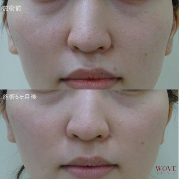 ダーマペン（全顔）ヴェルヴェットスキン5回