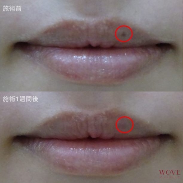 シミ取りレーザー1回