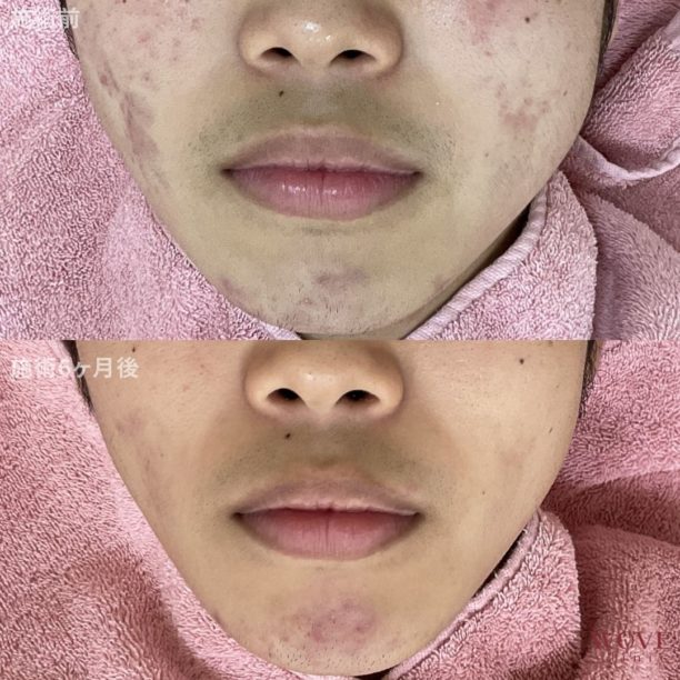 フラクショナル炭酸ガスレーザー（両頬＋顎）3回