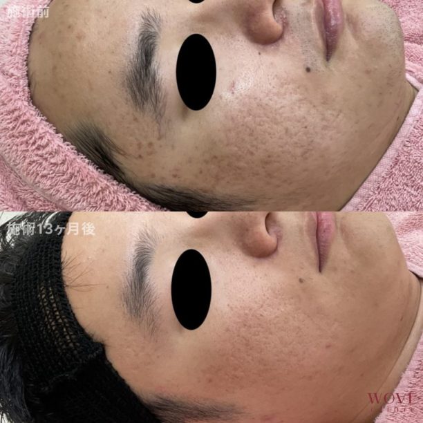 フラクショナル炭酸ガスレーザー（両頬）5回・ケミカルピーリング＆導入5回・ヒゲ脱毛（鼻下＋アゴ＋頬＋首前面のヒゲ部分のみ）4回