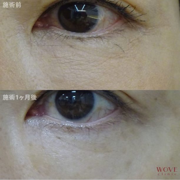 ベビーコラーゲン注射1回