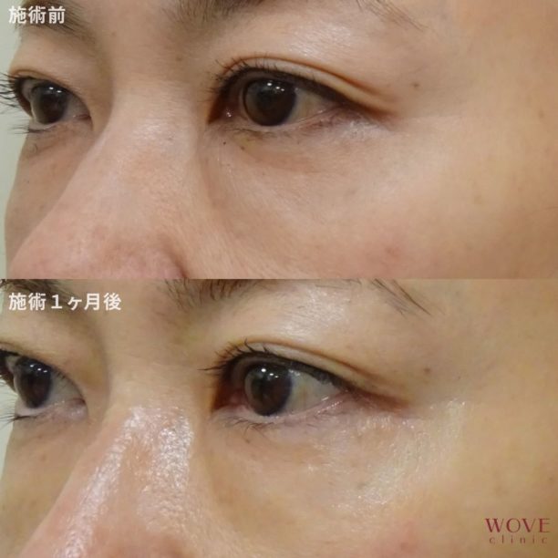 リジュラン注射１回