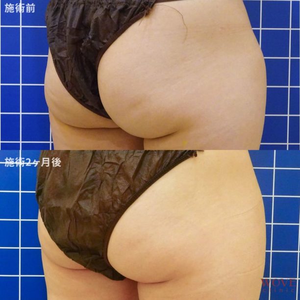 エムスカルプト（臀部）8回