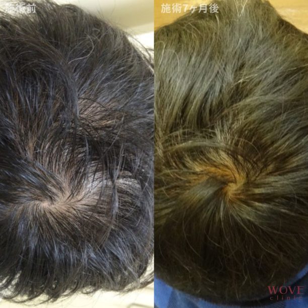 育毛メソセラピー13回